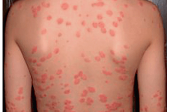 Psoriasis de l’enfant : prendre en compte les particularités liées à l’âge